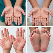 Hand Foot and Mouth Disease Outbreak